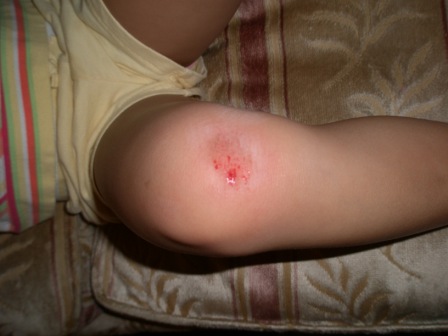 Kasen with a hurt knee (close-up)
